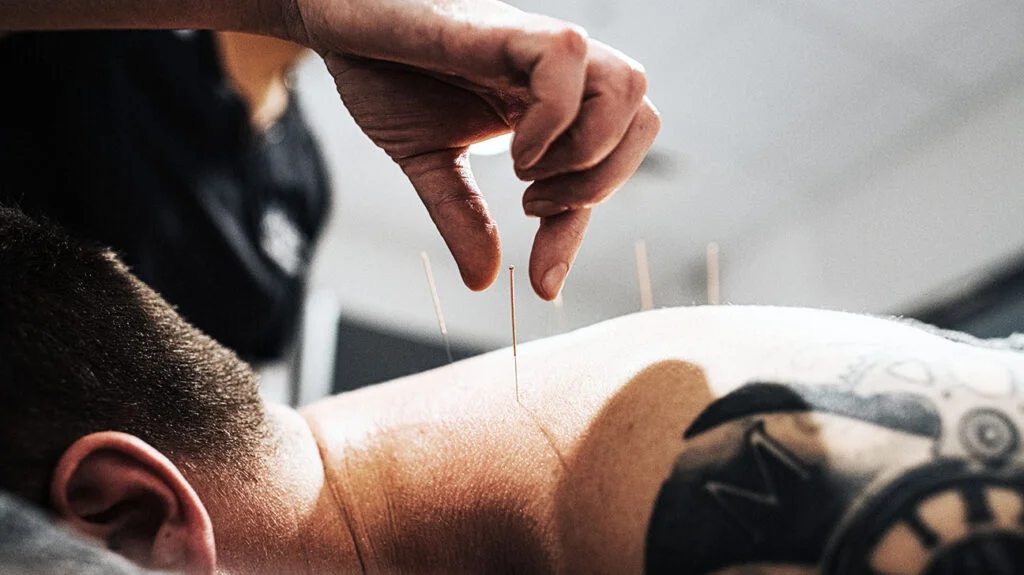 Acupuncture: A Global Phenomenon