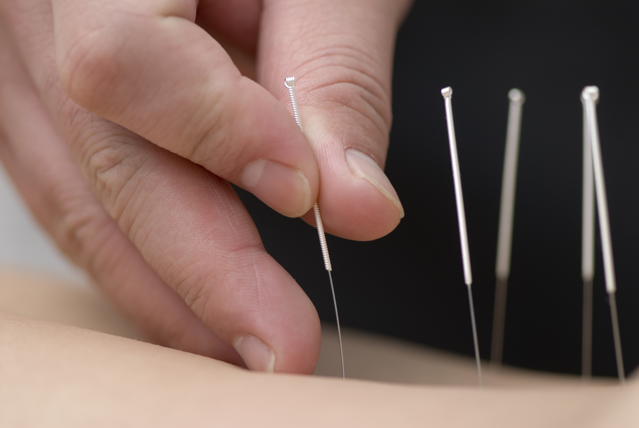 Unraveling the Ancient Roots of Acupuncture: A Journey Through Time